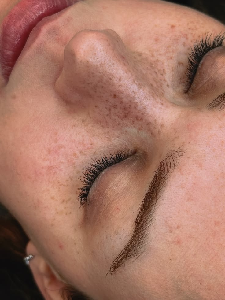 Caso real autorizado de micropigmentación de pecas y freckles en Nohuska Granollers