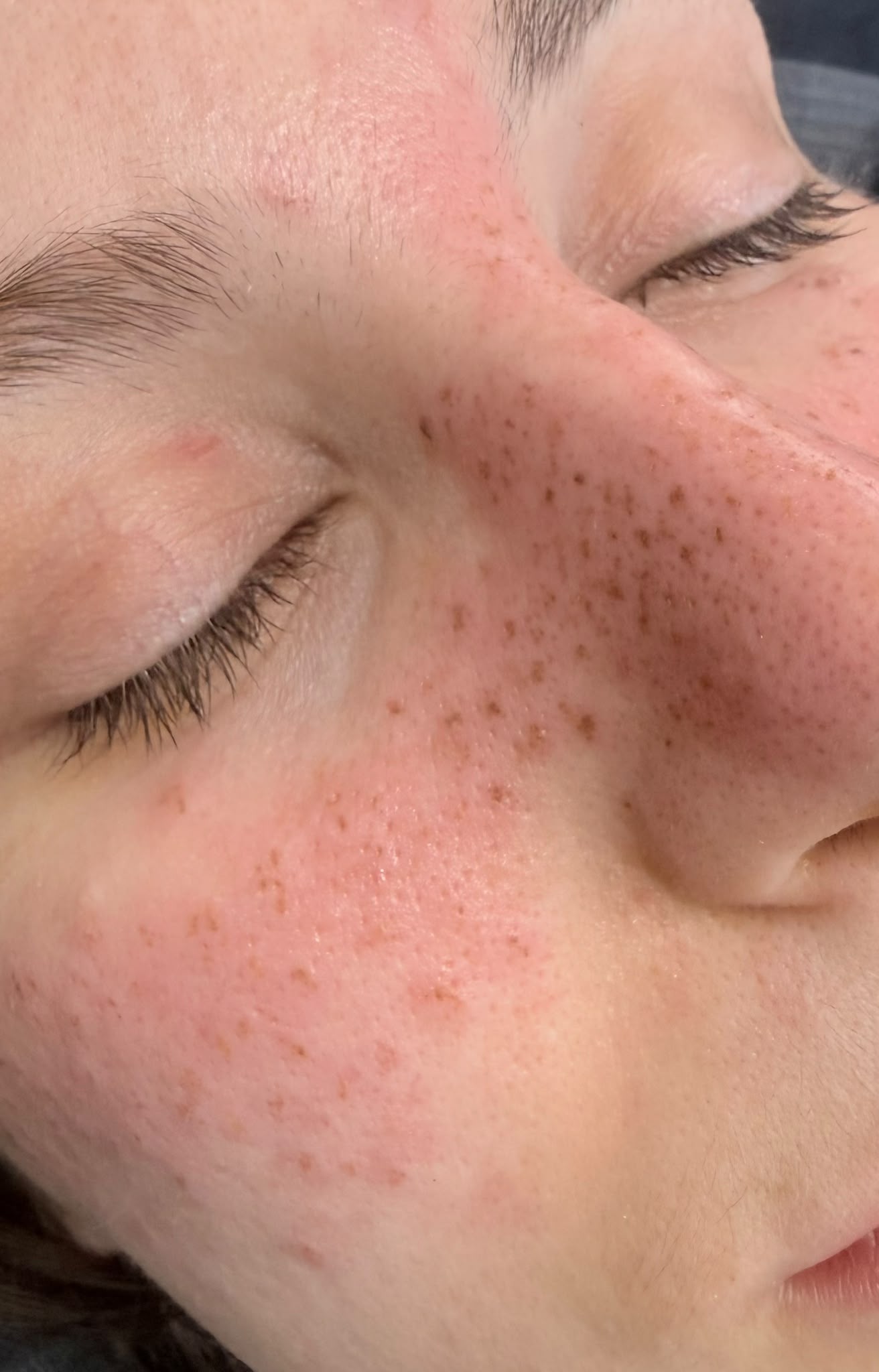 Resultado real de freckles realizadas por Nohuska en Granollers, España