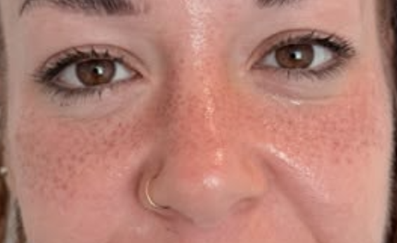 Resultado real de freckles semipermanentes realizado por Nohuska